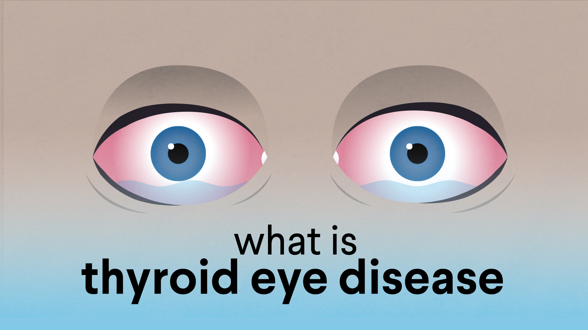 What Is Thyroid Eye Disease American Association Of Clinical